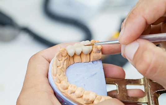 Garland dentist making dental bridge