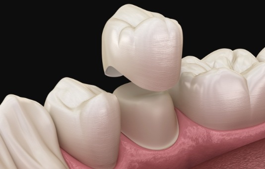 Animated smile during metal free dental restoration placement