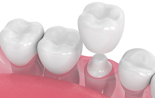 Closeup of dental crowns in Garland