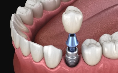 Animated smile during dental implant supported dental crown placement