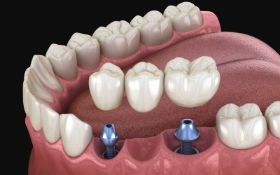 Animated smile during dental implant supported fixed bridge placement