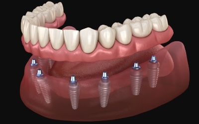 Animated smile during dental implant supported denture placement