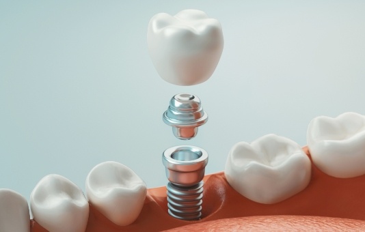 Animated smile during dental implant placement