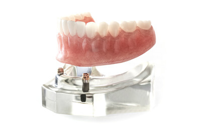 model of implant dentures