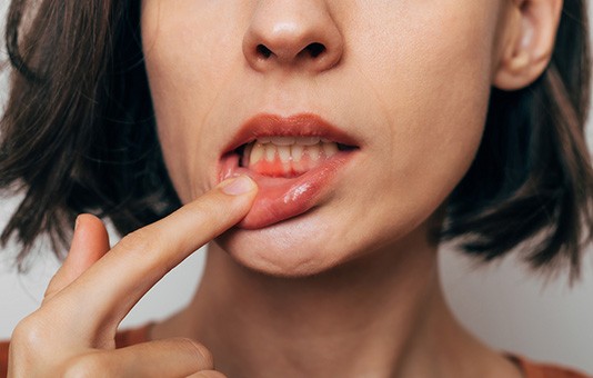 Woman pointing to irritated gums