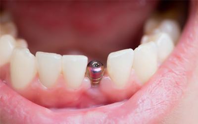 An implant surgery, which affects the cost of dental implants in Garland