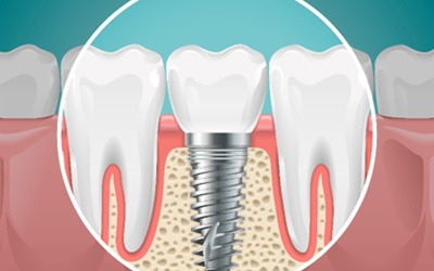 A model of implant parts, which affect the cost of dental implants in Garland