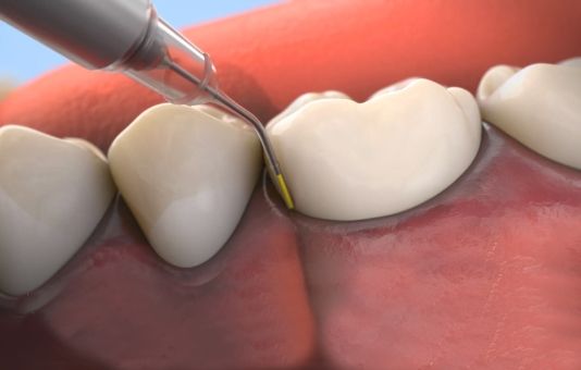 Animated smile during antibiotic therapy