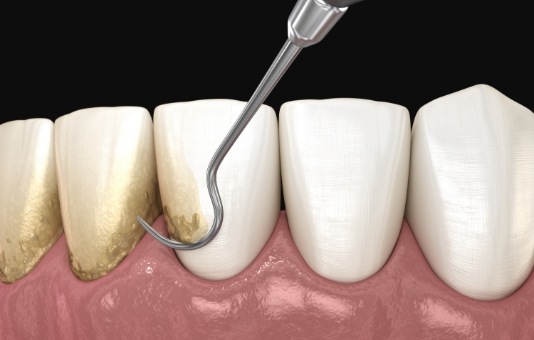 Animated smile during scaling and root planing