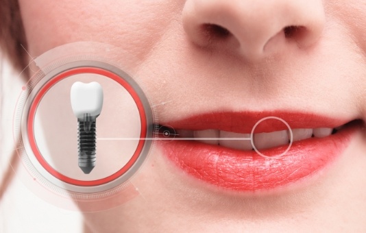 Smil with dental implant supported replacement tooth example