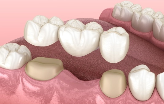 Animated smile during dental bridge placement