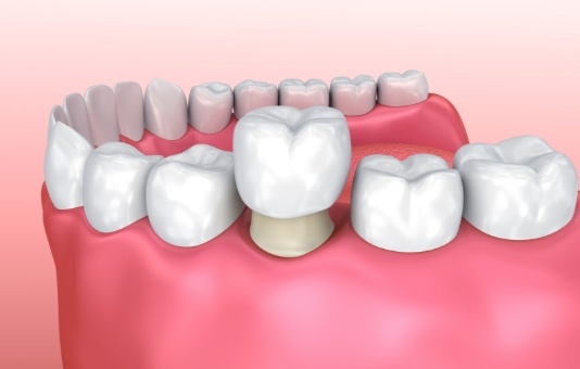 Animated smile during dental crown palcement