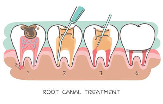 Diagram of a root canal