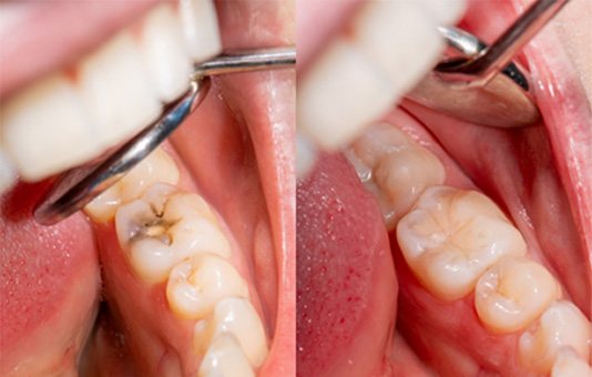 a before-and-after photo of a tooth with a filling