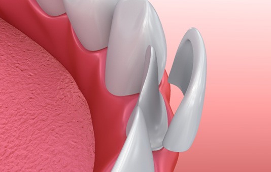 Illustration of veneer in Garland being applied to tooth
