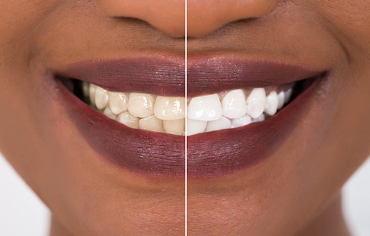Closeup of woman's smile before and after teeth whitening