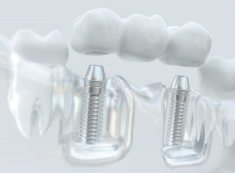 3D rendering of a dental bridge being placed on an implant