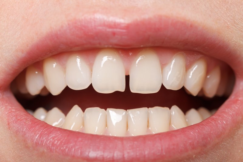 close up of a smile with gapped teeth