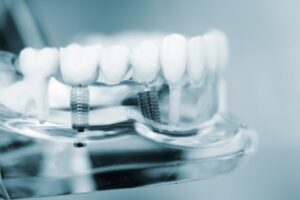 Black and white rendering of dental implant shown in mouth.