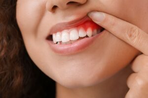 Woman pulling up lip to show gum disease. 